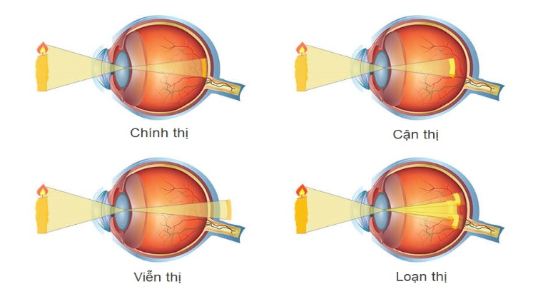 Co-che-tao-anh-mat-binh-thuong-va-mat-co-tat-khuc-xa