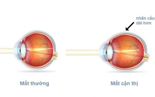 truc-nhan-cau-cua-mat-binh-thuong-va-mat-can-thi