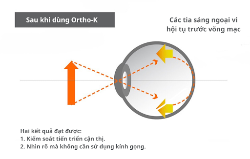 Kinh-ortho-K