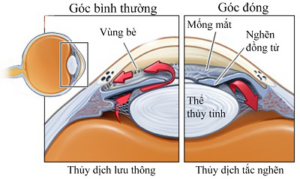 co-che-glocom-goc-dong-do-nghen-dong-tu