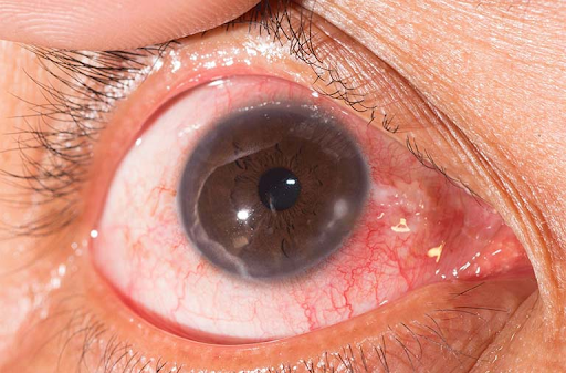 Acute conjunctivitis