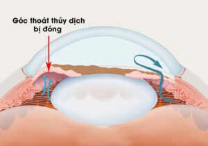 co-che-glocom-goc-dong-do-nghen-goc-tien-phong