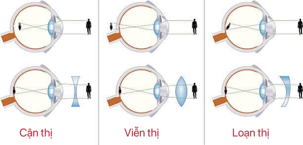 Mat-nhin-mo-co-phai-bi-can-khong